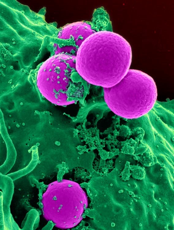 A germ that lives in the upper respiratory tract called Streptococcus pneumoniae is to blame when it comes to the development of bacterial pneumonia. As you might guess, this germ is also the cause of strep throat, but it is linked to everything from pneumonia to toxic shock syndrome, impetigo, and scarlet fever as well.