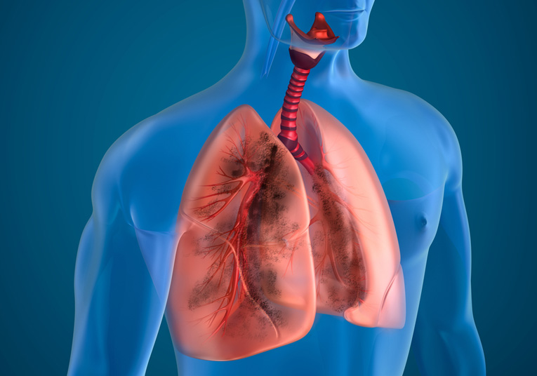 THE SYMPTOMS OF LUNG DISEASE
